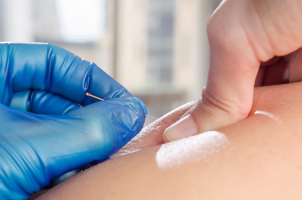 Punción seca fisioterapia en Ourense